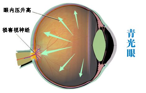 患青光眼为什么会失明?