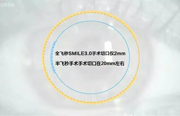 重磅发布：全飞秒SMILE3.0智能升级