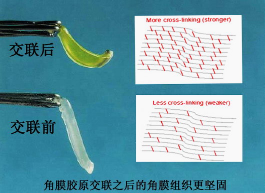 角膜胶原交联技术——激光近视手术加固新防线